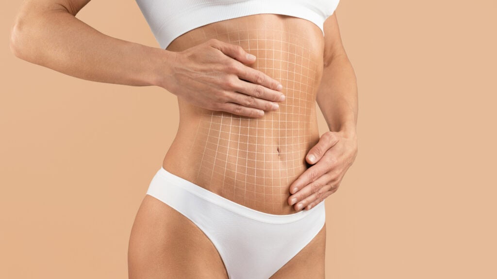 liposuction and tummy tuck with Dr. Morales