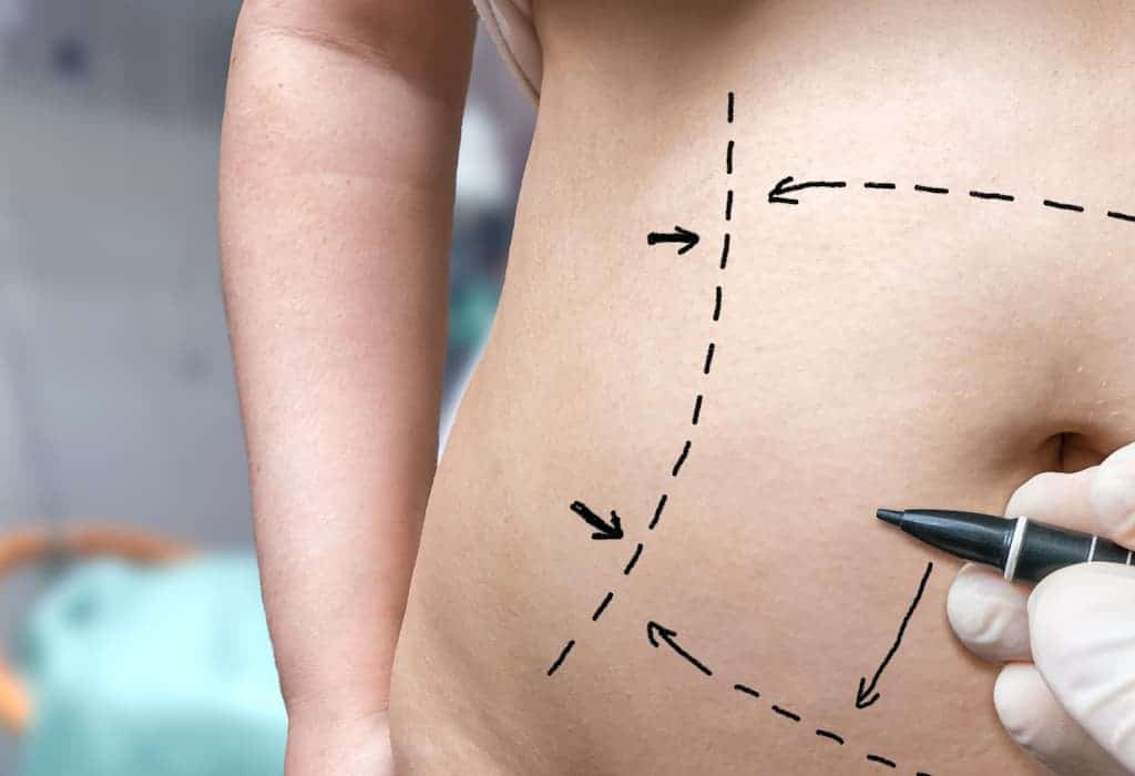 Surgeon marking abdomen with surgical lines and arrows for tummy tuck procedure planning, demonstrating pre-operative assessment affecting treatment cost