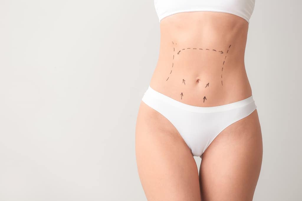 Woman's abdomen with surgical marking lines and arrows for tummy tuck procedure planning, demonstrating pre-operative assessment that influences recovery timeline and healing process