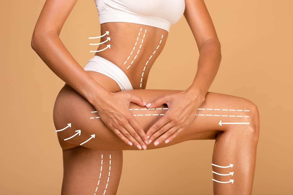 Woman showing body contour lines on abdomen, thighs, and buttocks to illustrate skin tightening and sculpting results from Renuvion treatment.