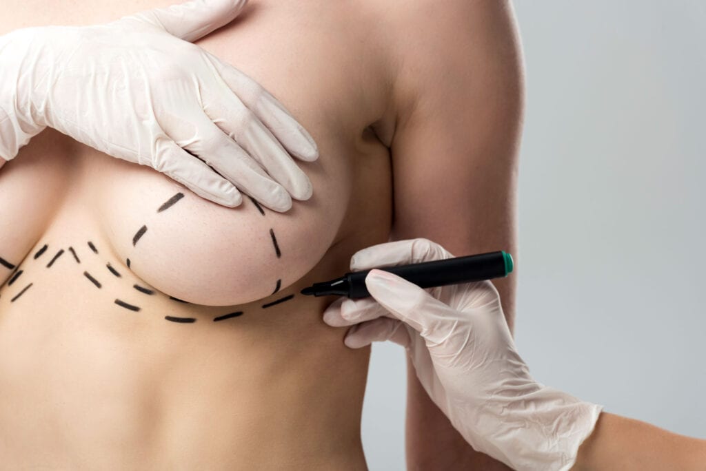 Surgeon marking the breast with surgical lines during a breast lift vs breast reduction consultation.